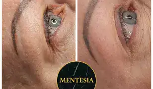 Fusion Plasma arc és szemhéj feszesítés