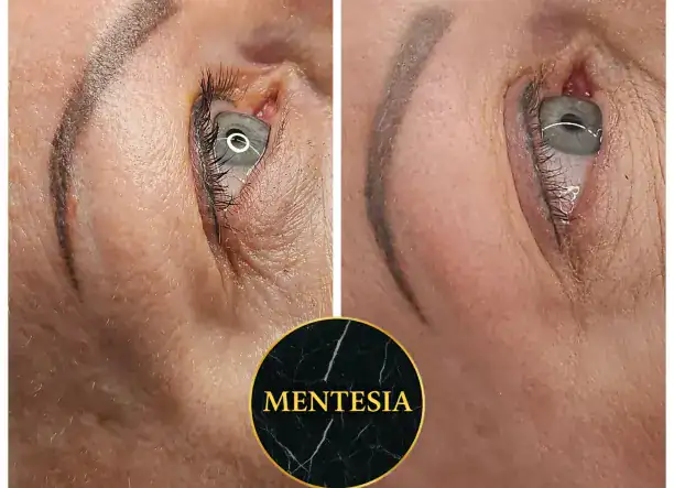 Fusion Plasma arc és szemhéj feszesítés