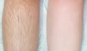Tartós szőrtelenítés IPL/SHR