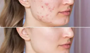 Problémás bőr kezelő csomag a Váci47 szépségszalonban