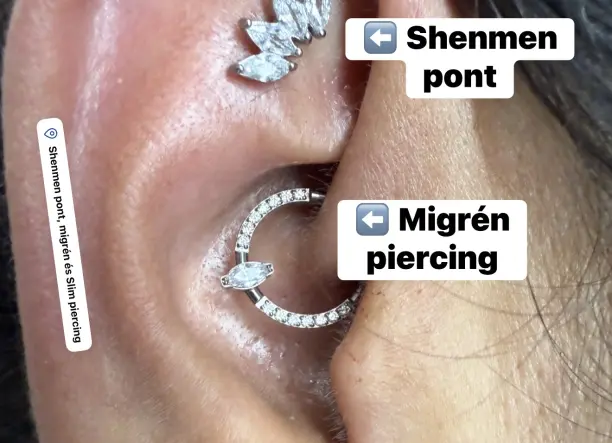 Shenmen pont, Migrén és Slim piercing