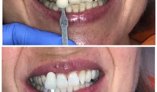 Renta Bright Smile- Fogfehérítés Akció!!