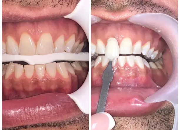 Renta Bright Smile- Fogfehérítés Akció!!