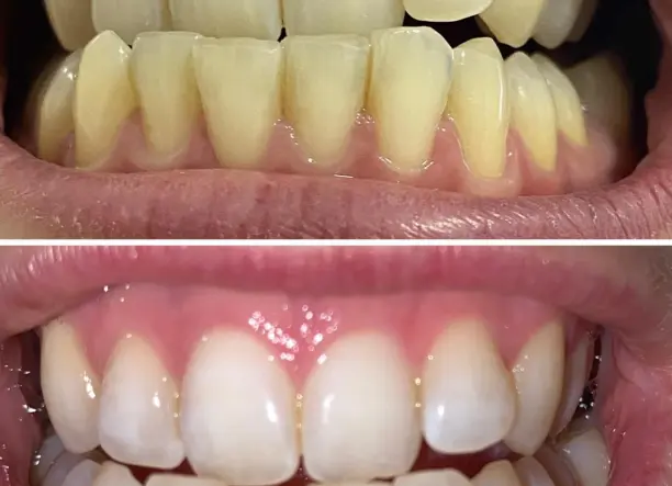 Renta Bright Smile- Fogfehérítés Akció!!