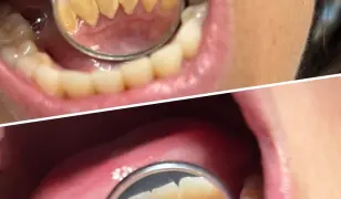 Renta Bright Smile- Fogkőeltávolítás