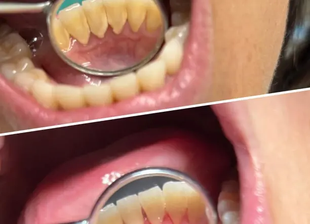 Renta Bright Smile- Fogkőeltávolítás