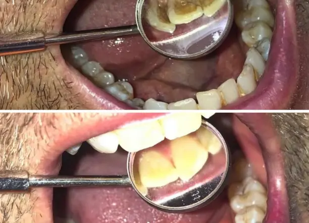 Renta Bright Smile- Fogkőeltávolítás