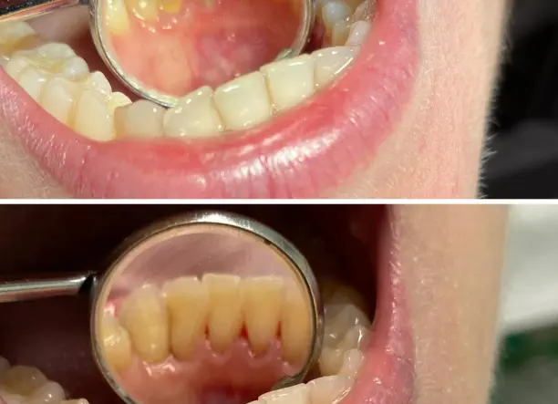 Renta Bright Smile- Fogkőeltávolítás