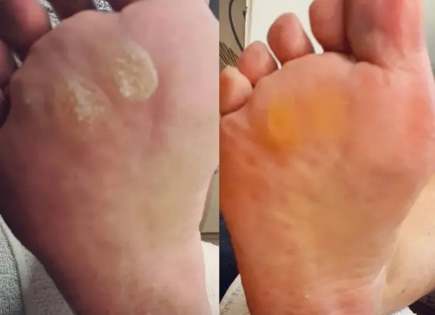 Gyógypedikűr szakszerűen!