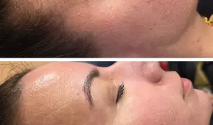 Glow Peel bőrmegújító kezelés - ClinicCare bőrmegújító kezelés