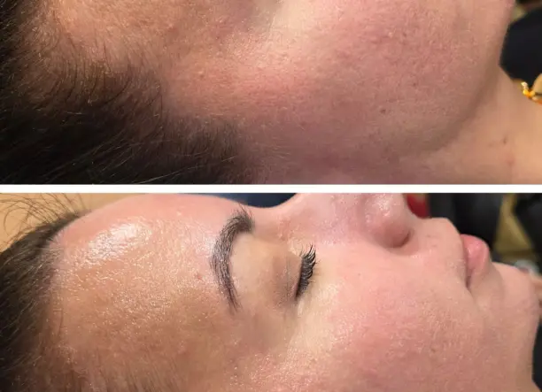 Glow Peel bőrmegújító kezelés - ClinicCare bőrmegújító kezelés