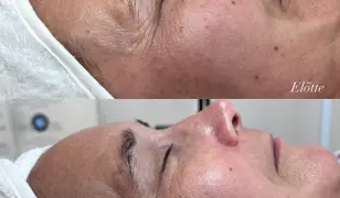 Carboxy terápia - ClinicCare bőrmegújító kezelés