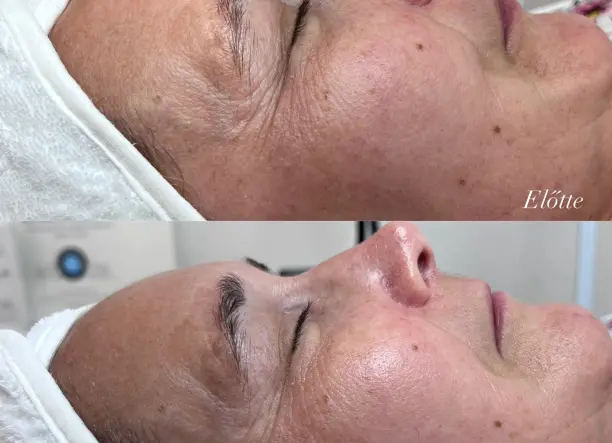 Carboxy terápia - ClinicCare bőrmegújító kezelés