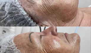 Hamupipőke villám bőrmegújító kezelés