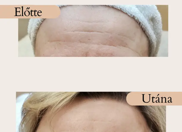 Szérumos arcmasszázs 10% AKCIÓ + ajándék