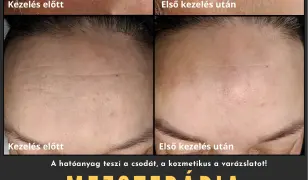 Mezoterápiás arckezelés