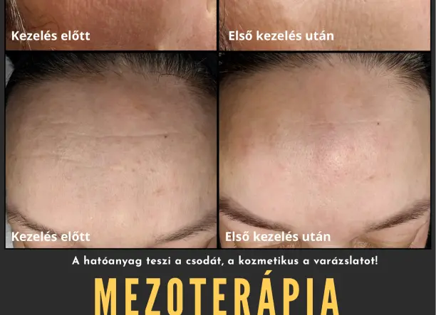 Mezoterápiás arckezelés