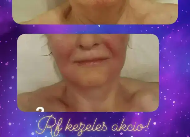 Rádiófrekvenciás arc-nyak-dekoltázs fiatalítás, feszesítés