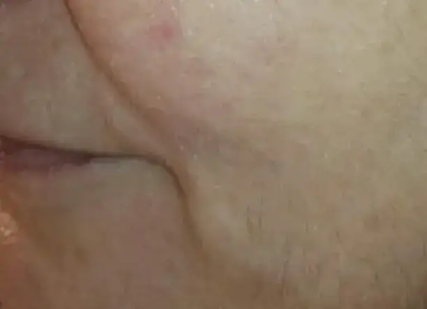 Rádiófrekvenciás arc-nyak-dekoltázs fiatalítás, feszesítés