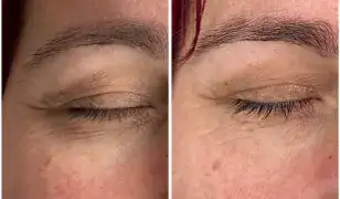 Fasciális arcmasszázs Újbudán - természetes lifting