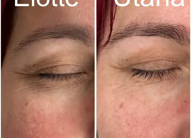 Fasciális arcmasszázs Újbudán - természetes lifting