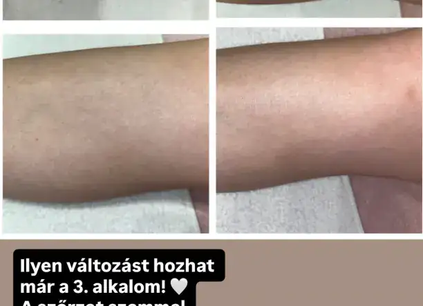 Lézeres szolgáltatások