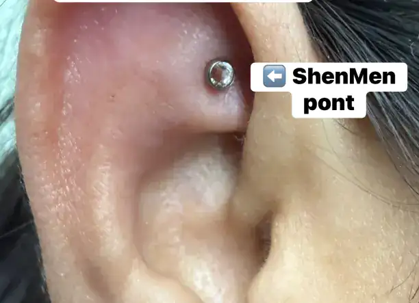 ShenMen pont & Migrén piercing GÉPI beméréssel